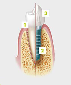 Overview of Dental Implant Treatment